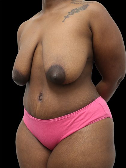 Breast Lift Before & After Patient #2491