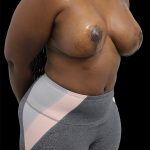 Breast Lift Before & After Patient #2491