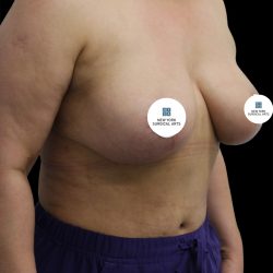 Breast Lift Before & After Patient #2492