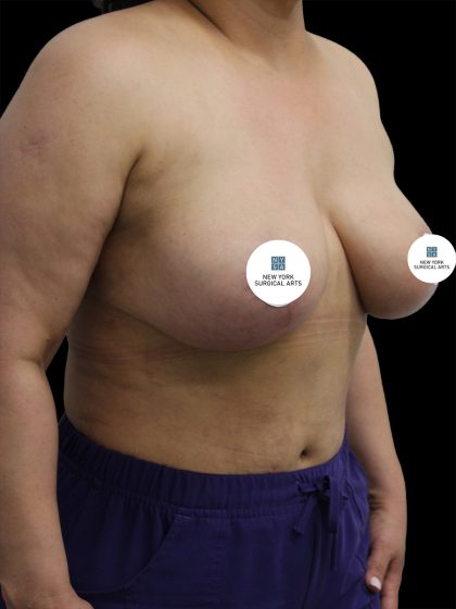 Breast Lift Before & After Patient #2492
