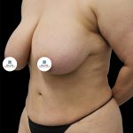 Breast Lift Before & After Patient #2492