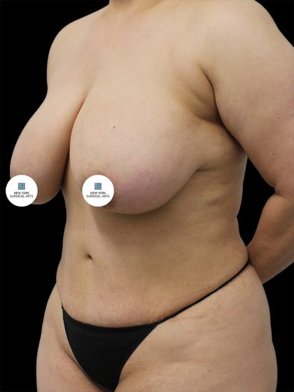 Breast Lift Before & After Patient #2492