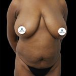 Breast Lift Before & After Patient #2493