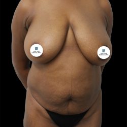 Breast Lift Before & After Patient #2493