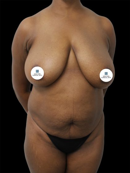Breast Lift Before & After Patient #2493