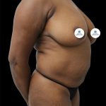 Breast Lift Before & After Patient #2493
