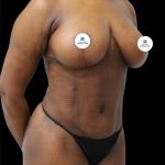 Breast Lift Before & After Patient #2493