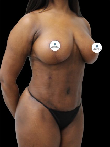 Breast Lift Before & After Patient #2493