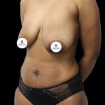 Breast Lift Before & After Patient #2494