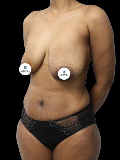 Breast Lift Before & After Patient #2494