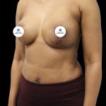 Breast Lift Before & After Patient #2494