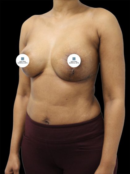 Breast Lift Before & After Patient #2494