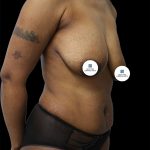 Breast Lift Before & After Patient #2494