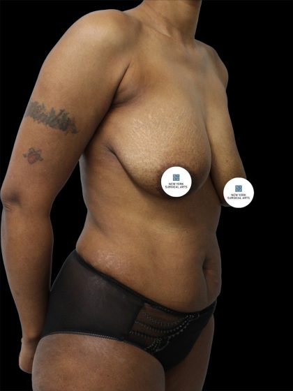 Breast Lift Before & After Patient #2494