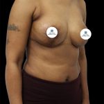 Breast Lift Before & After Patient #2494