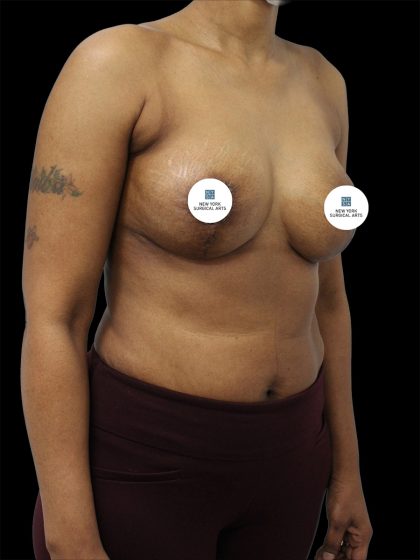 Breast Lift Before & After Patient #2494