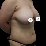 Breast Lift Before & After Patient #2495