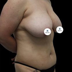 Breast Lift Before & After Patient #2495
