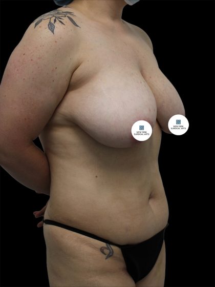 Breast Lift Before & After Patient #2495