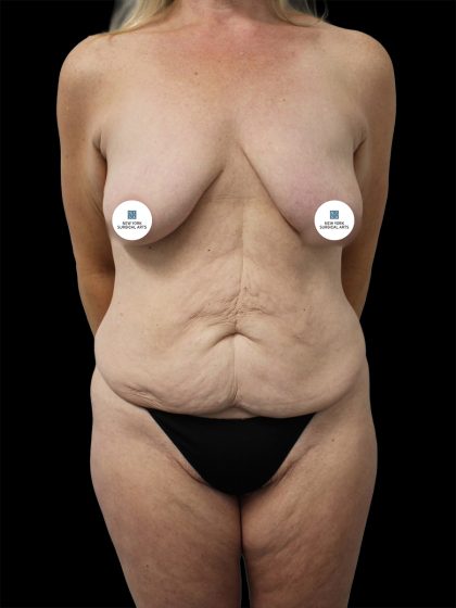 Breast Lift Before & After Patient #2496