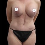 Breast Lift Before & After Patient #2496