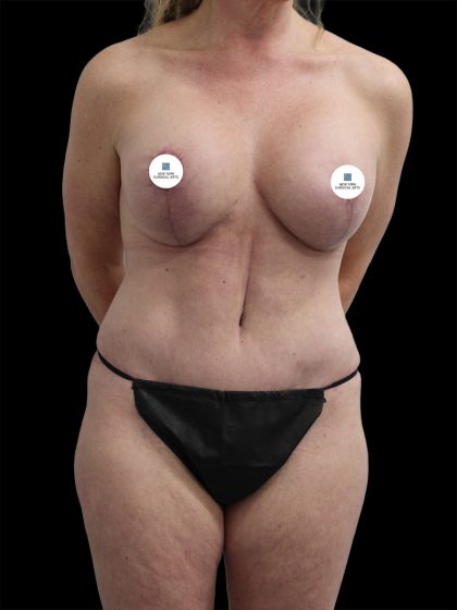 Breast Lift Before & After Patient #2496