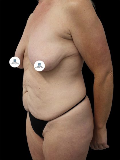 Breast Lift Before & After Patient #2496