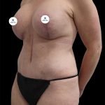 Breast Lift Before & After Patient #2496