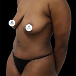 Breast Lift Before & After Patient #2513