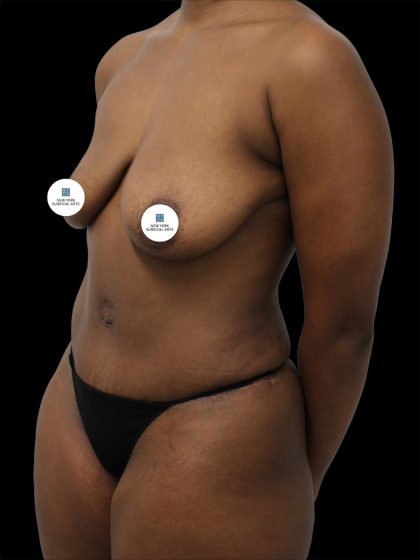 Breast Lift Before & After Patient #2513