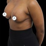 Breast Lift Before & After Patient #2513