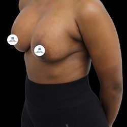 Breast Lift Before & After Patient #2513