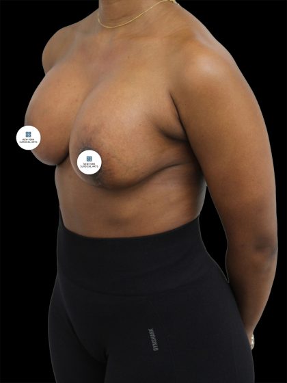 Breast Lift Before & After Patient #2513