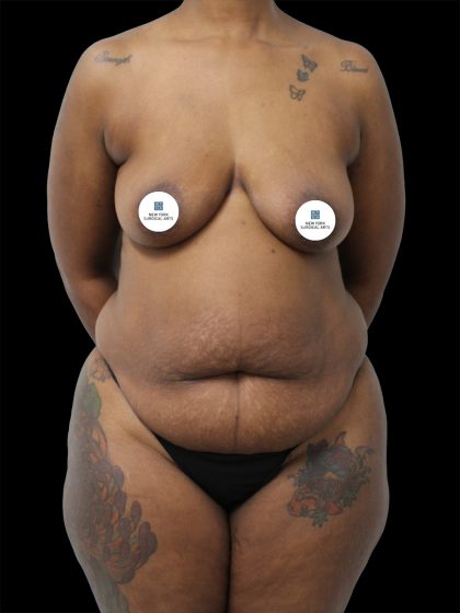 Breast Lift Before & After Patient #2514