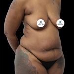 Breast Lift Before & After Patient #2514