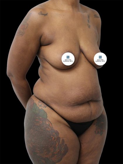 Breast Lift Before & After Patient #2514