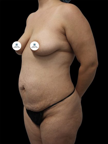Breast Lift Before & After Patient #2516