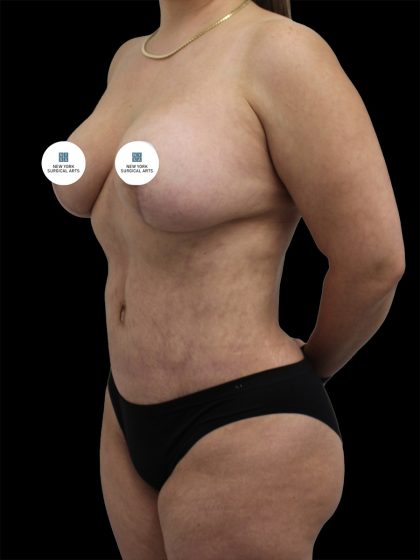 Breast Lift Before & After Patient #2516