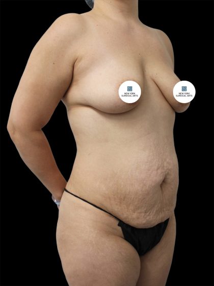 Breast Lift Before & After Patient #2516