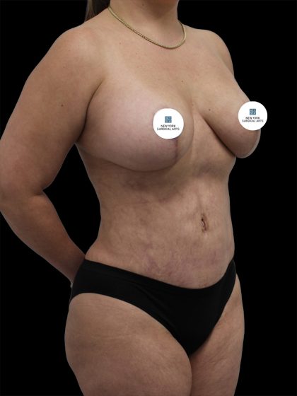 Breast Lift Before & After Patient #2516