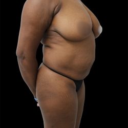 Breast Lift Before & After Patient #2488