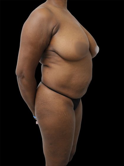 Breast Lift Before & After Patient #2488