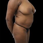 Breast Reduction Before & After Patient #2576