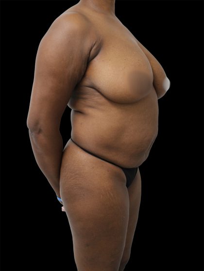 Breast Reduction Before & After Patient #2576