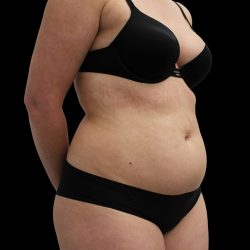 Abdominal Etching Before & After Patient #2589