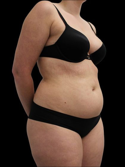 Abdominal Etching Before & After Patient #2589