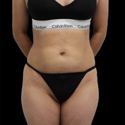 Liposuction Before & After Patient #2594