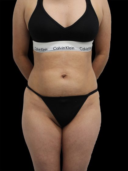 Liposuction Before & After Patient #2594