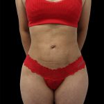 Liposuction Before & After Patient #2594