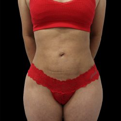 Liposuction Before & After Patient #2594